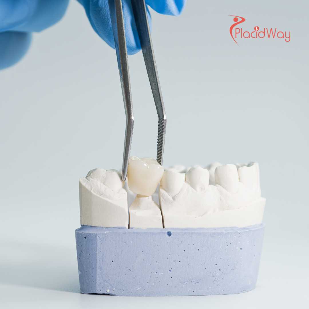 Dental Crown and Bridge Treatment in Mexico for U.S. Patients