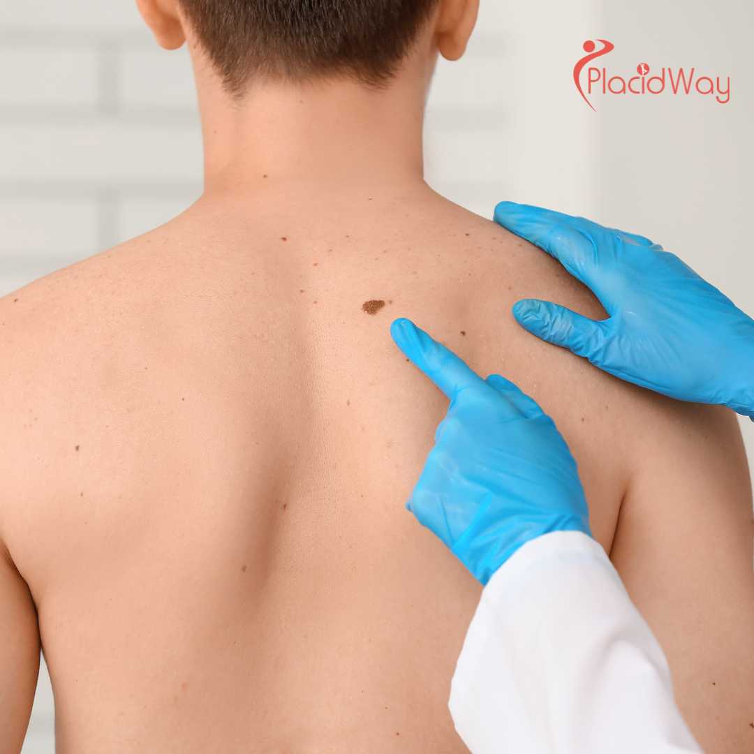 Advanced Melanoma Treatment in Tijuana - Targeting Metastasis When Standard Care Fails