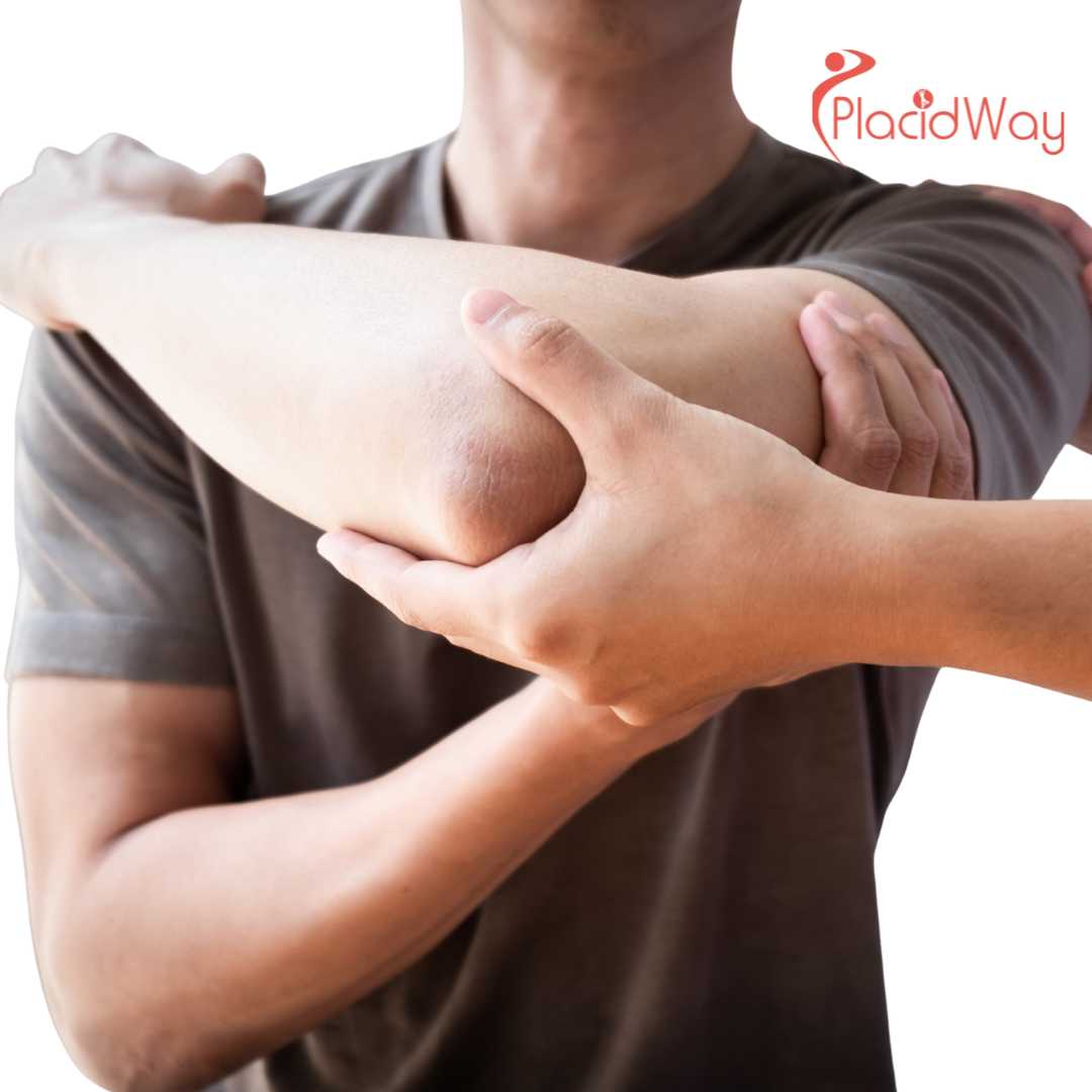 5 Things to Know About Rotator Cuff Surgery in Istanbul, Turkey