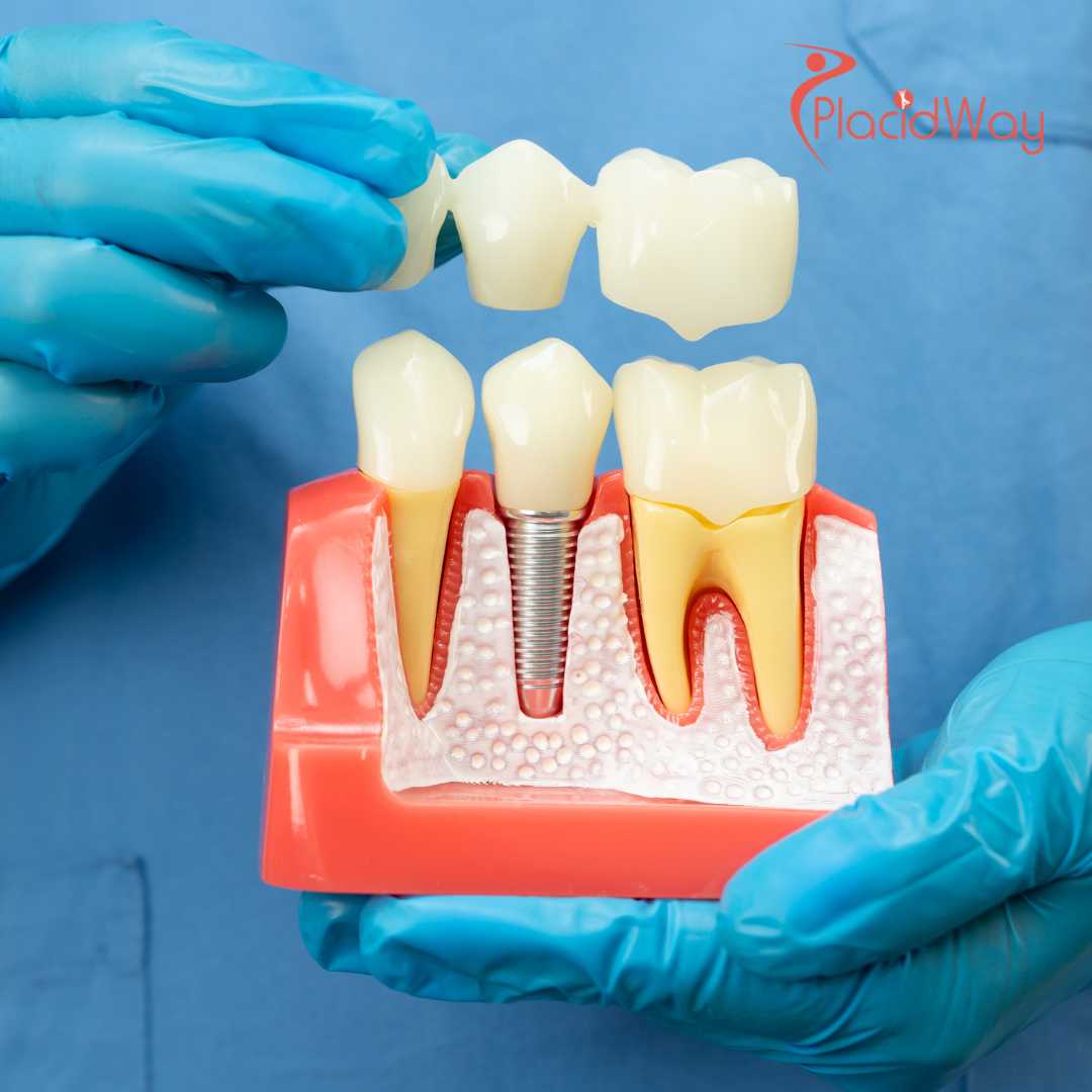 Capitalizing on EU Cross-Border Care: German Medical Tourists Drive Record Demand for Premium Dental Crowns in Croatia