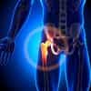 Seeking Treatment Abroad: Why Canadian Patients are Opting for Hip Replacement Surgery Outside their Home Country