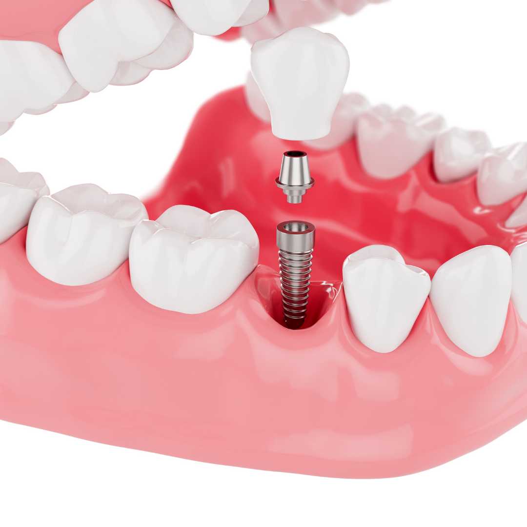 High-Quality Dental Implants in Colombia
