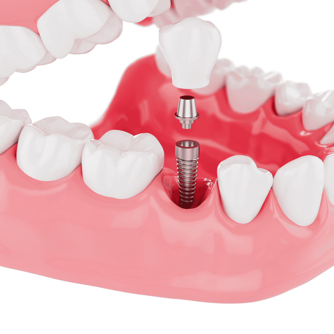 High-Quality Dental Implants in Colombia