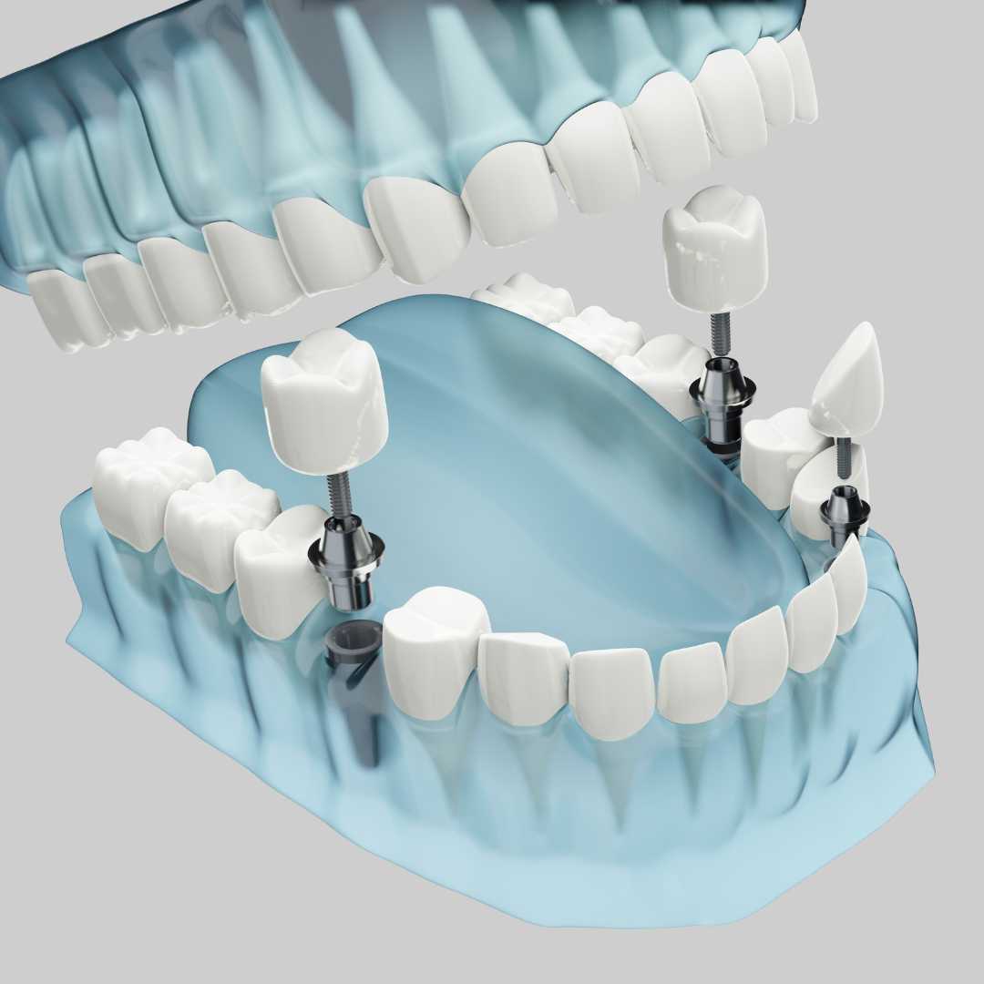 Your Complete Guide to All on 4 Dental Implants in Cancun Mexico