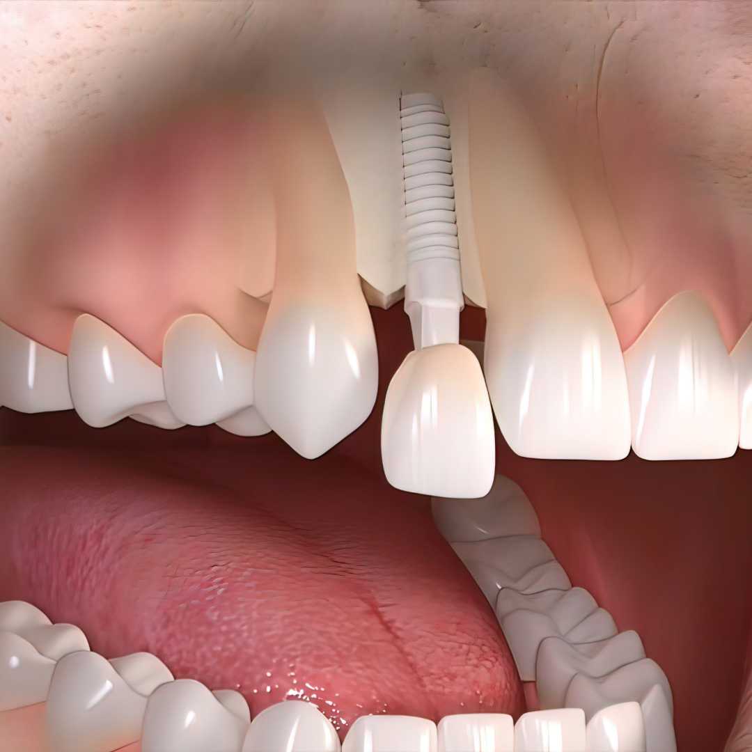 Dental Implants in Hungary for Your Confident Smile