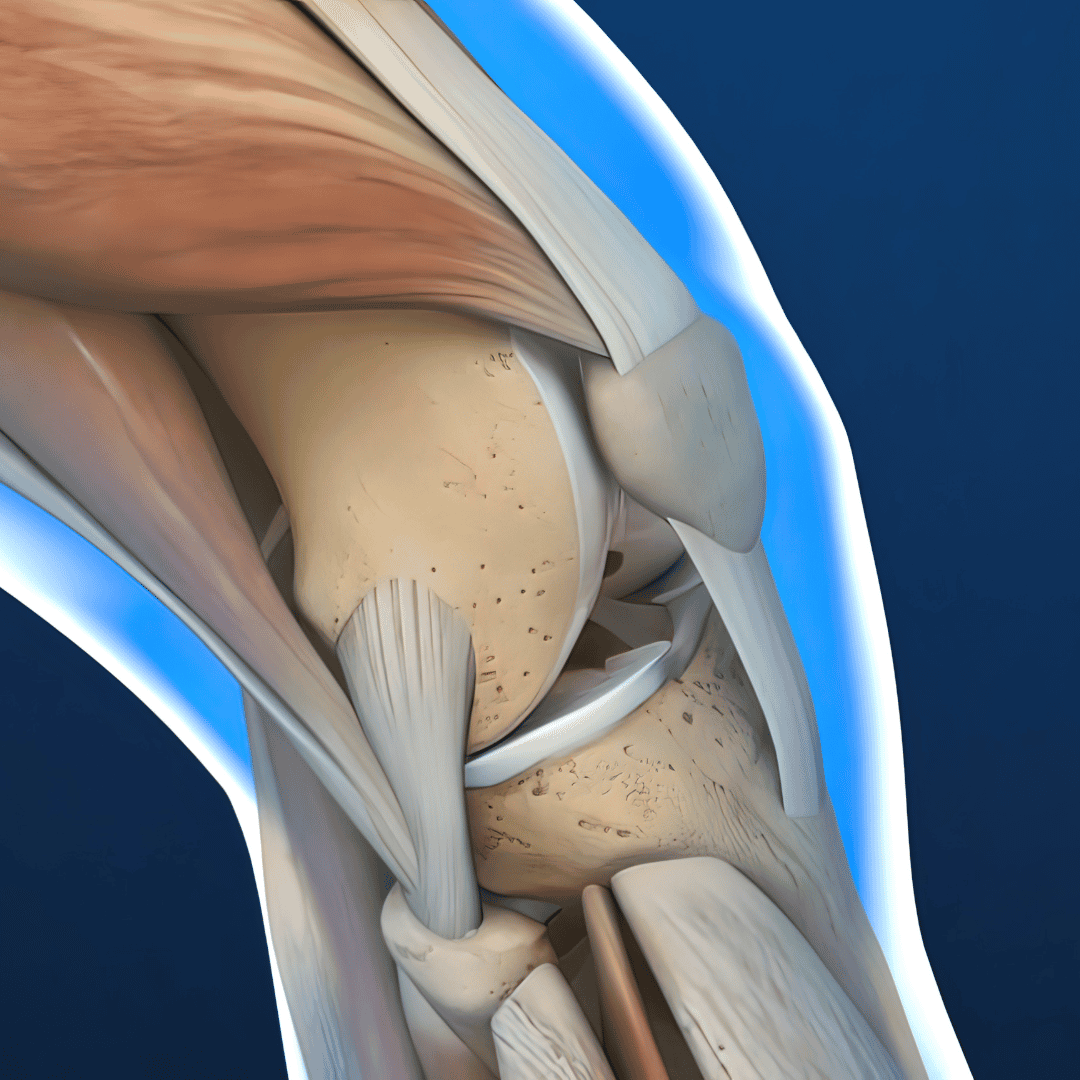 Meniscus Surgery in Cancun Mexico