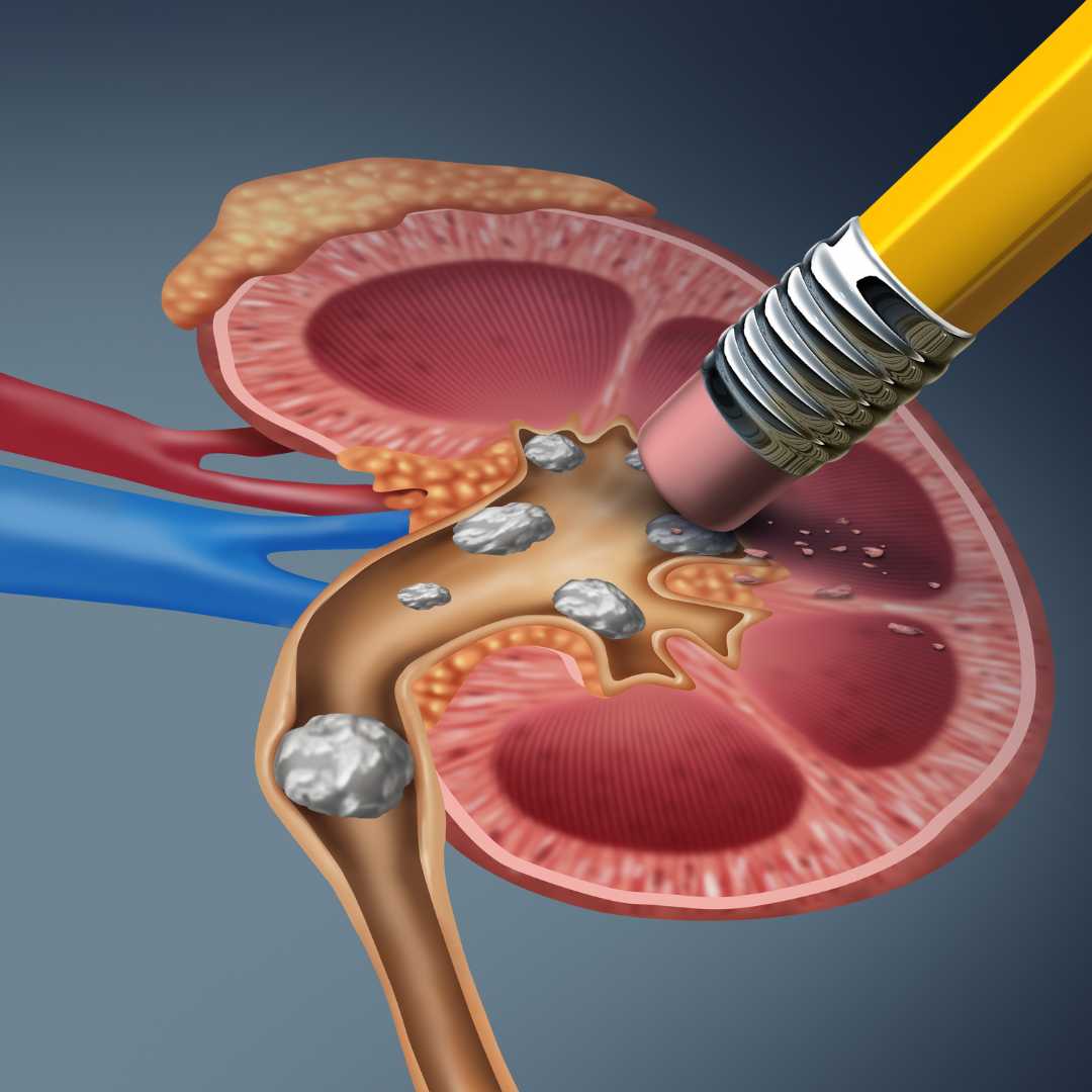 Kidney Stones Removal Surgery in Turkey