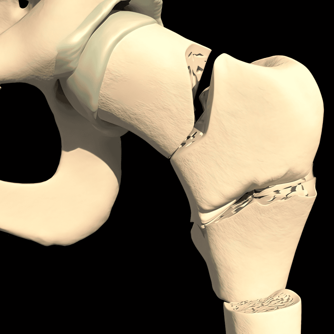 Hip Replacement Surgery in Europe