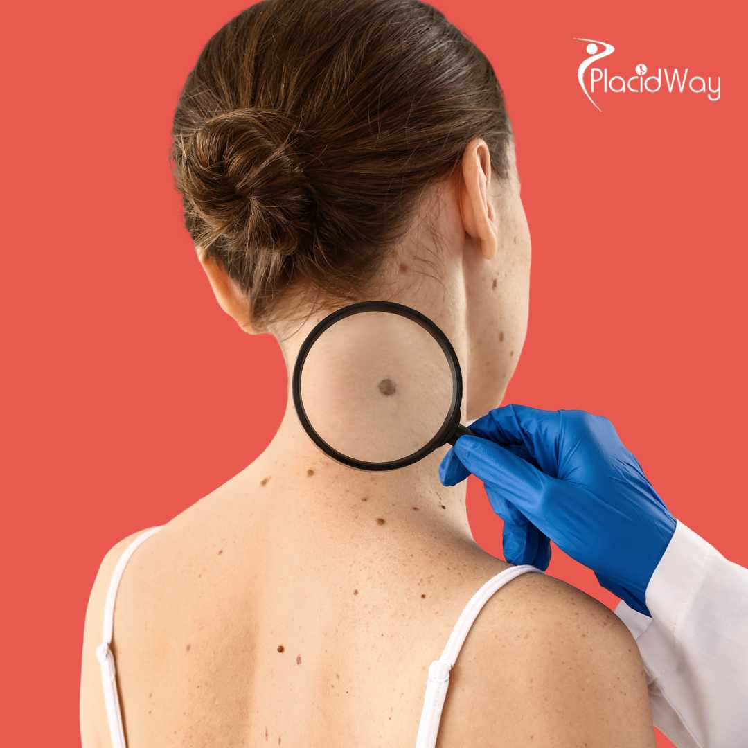 Immunotherapy China: TILs Therapy for Melanoma