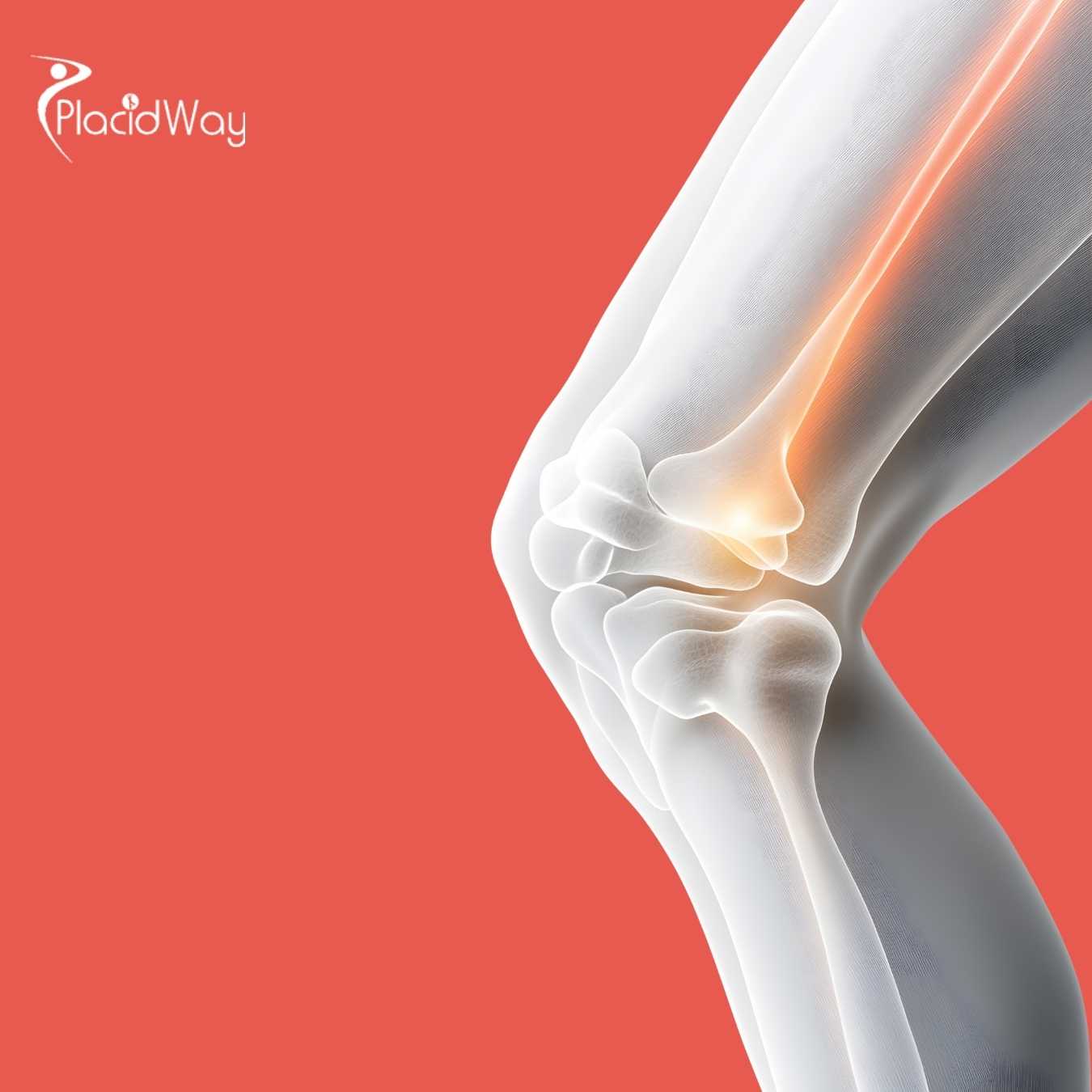 Best Knee Replacement in Cancun Mexico from Top-Rated Hospital