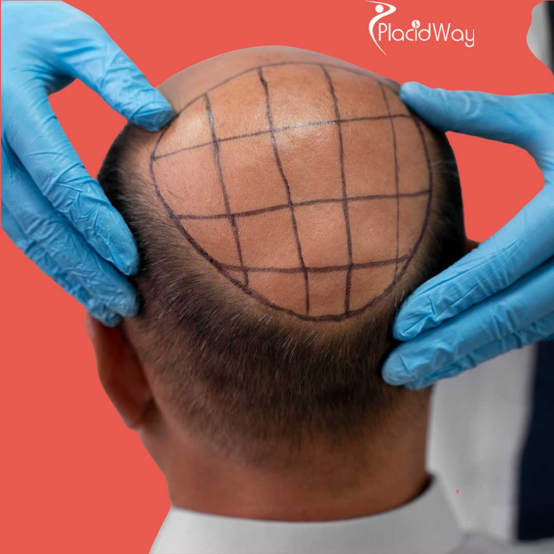 Hair Transplant in Turkey