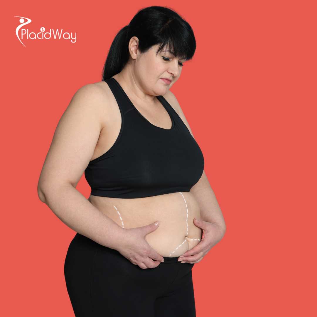 Tummy Tuck in Bangkok, Thailand