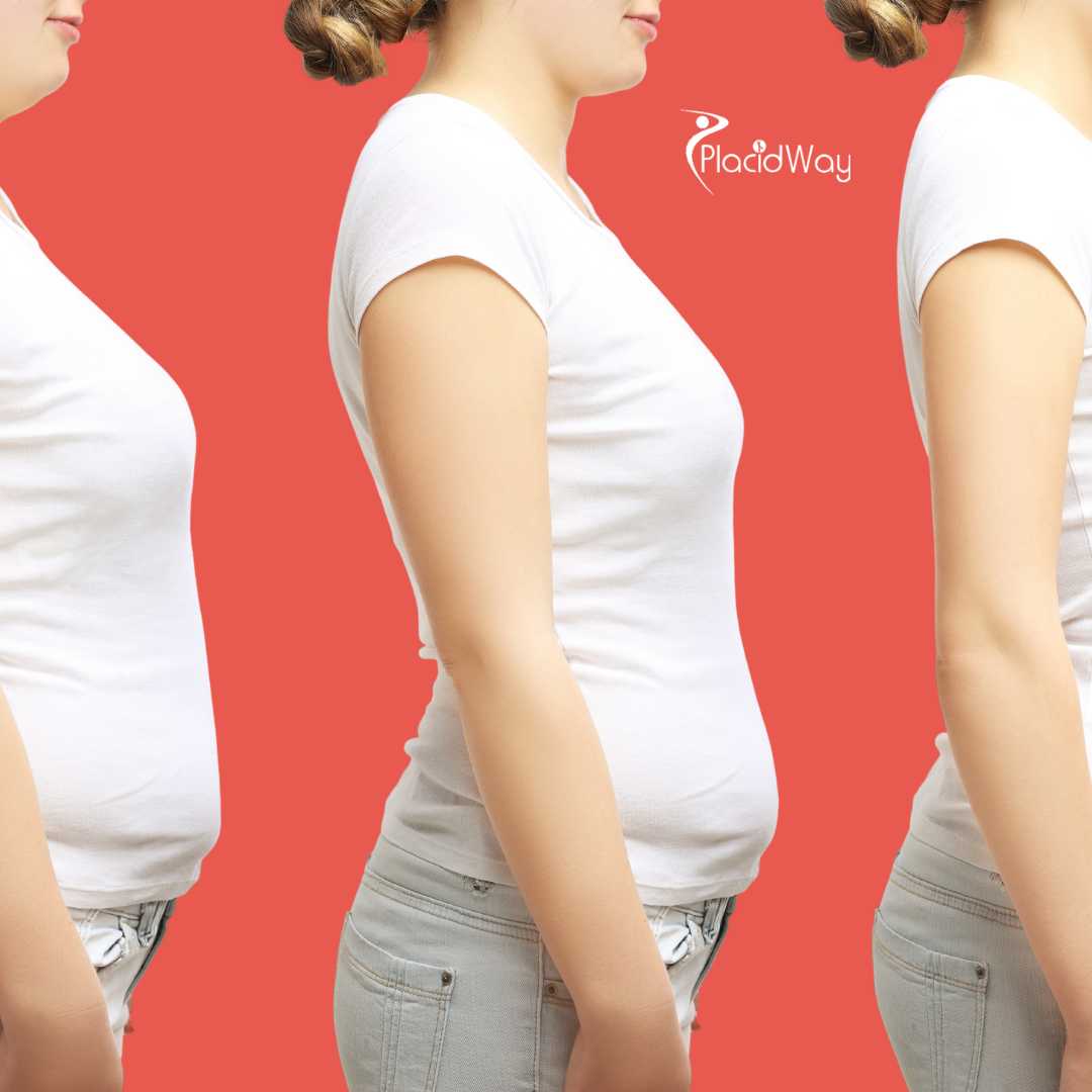 Gastric Sleeve Surgery in Piedras Negras, Mexico