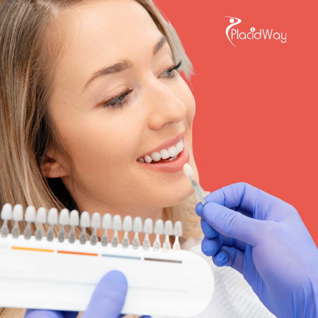 Dental Veneers in Puerto Vallarta Mexico