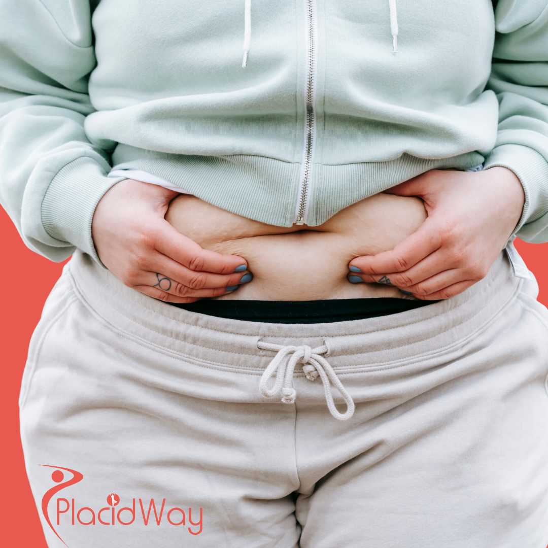 Tummy Tuck in Ankara, Turkey