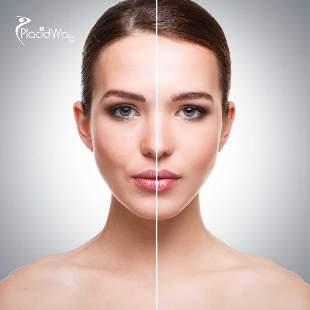 Mommy Makeover in Mexico City, Mexico