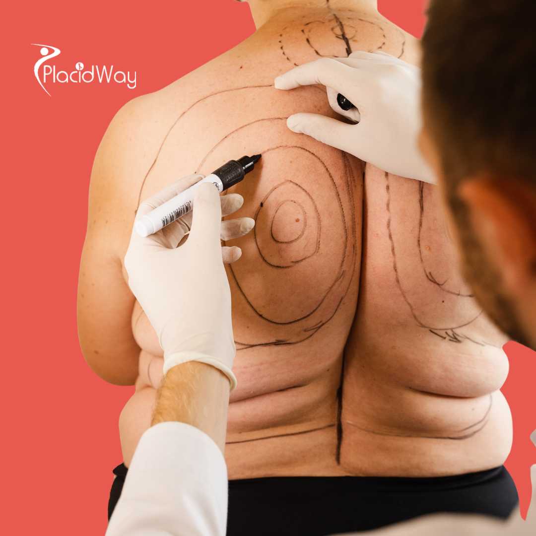 Liposuction in South Korea