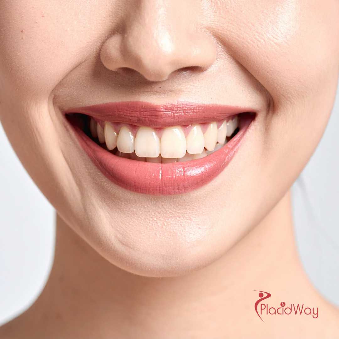 All on 6 Dental Implants in Turkey