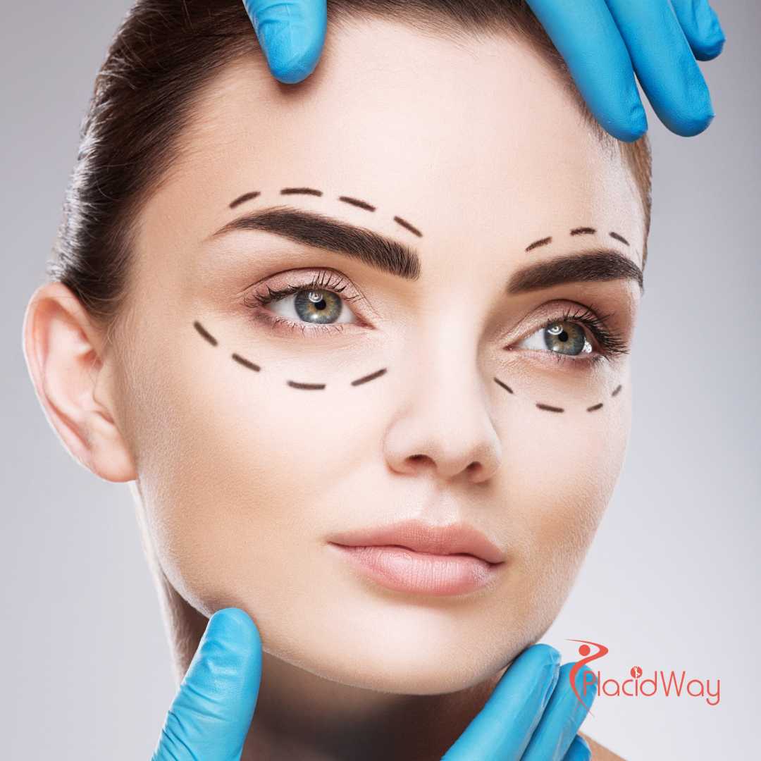 Eyelid Surgery in Istanbul, Turkey