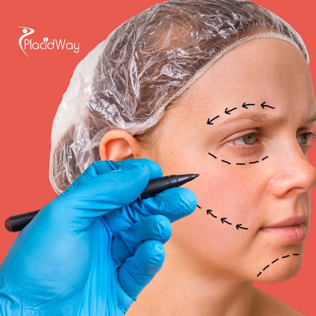 Deep Plane Facelift in Mexico