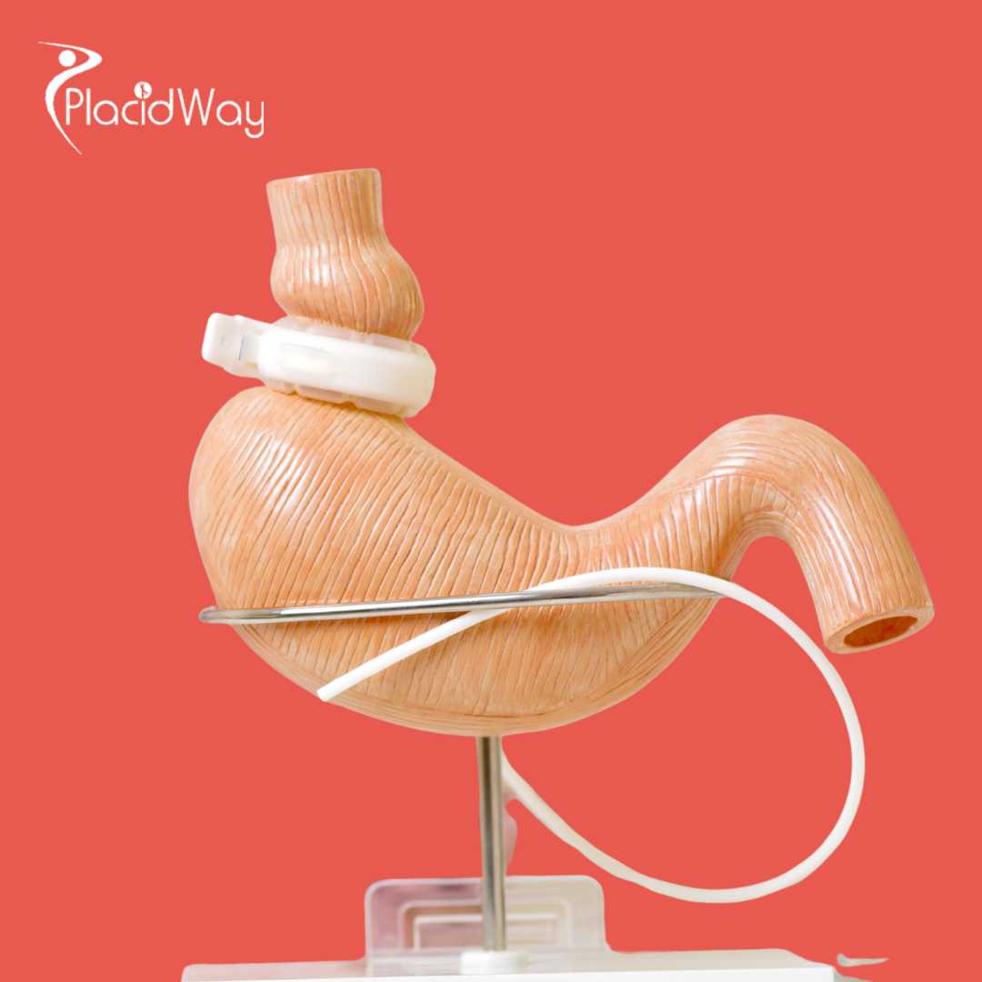 Bariatric Surgery in Cancun, Mexico - The Ultimate Guide