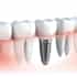 Survey-Are-you-a-suitable-candidate-for-dental-implants