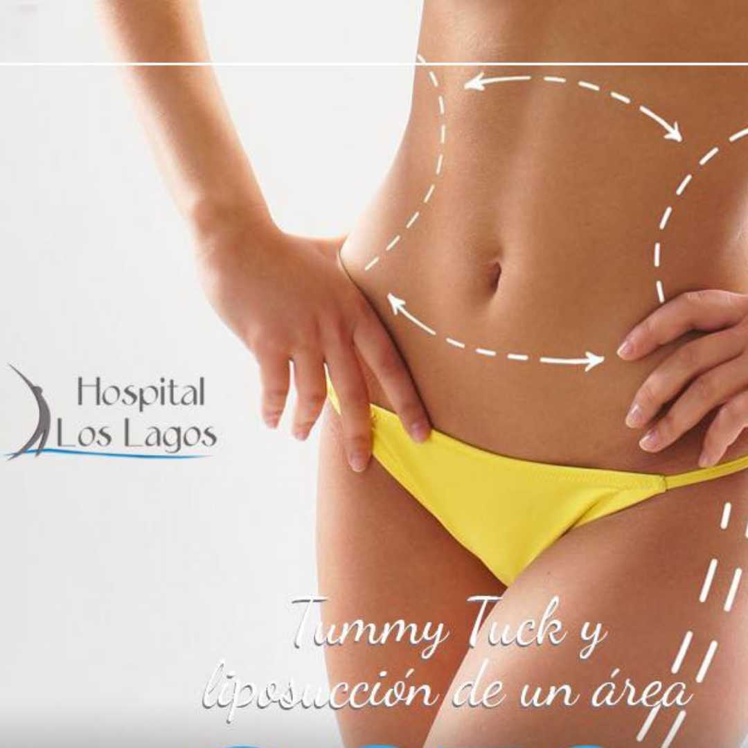 Tummy Tuck in Mexico with Liposuction in Reynosa - $6800