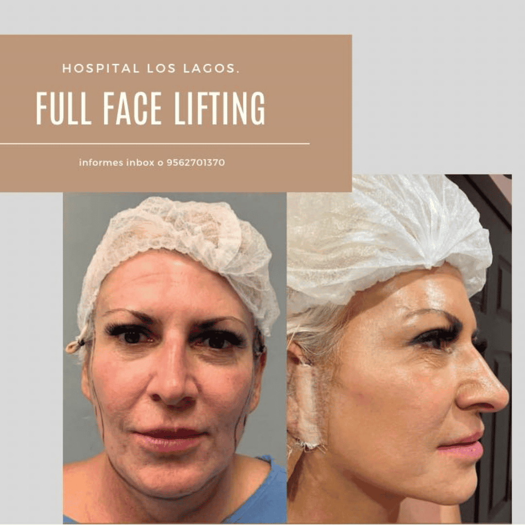 Face Lift Package in Reynosa, Mexico by Hospital Los Lagos