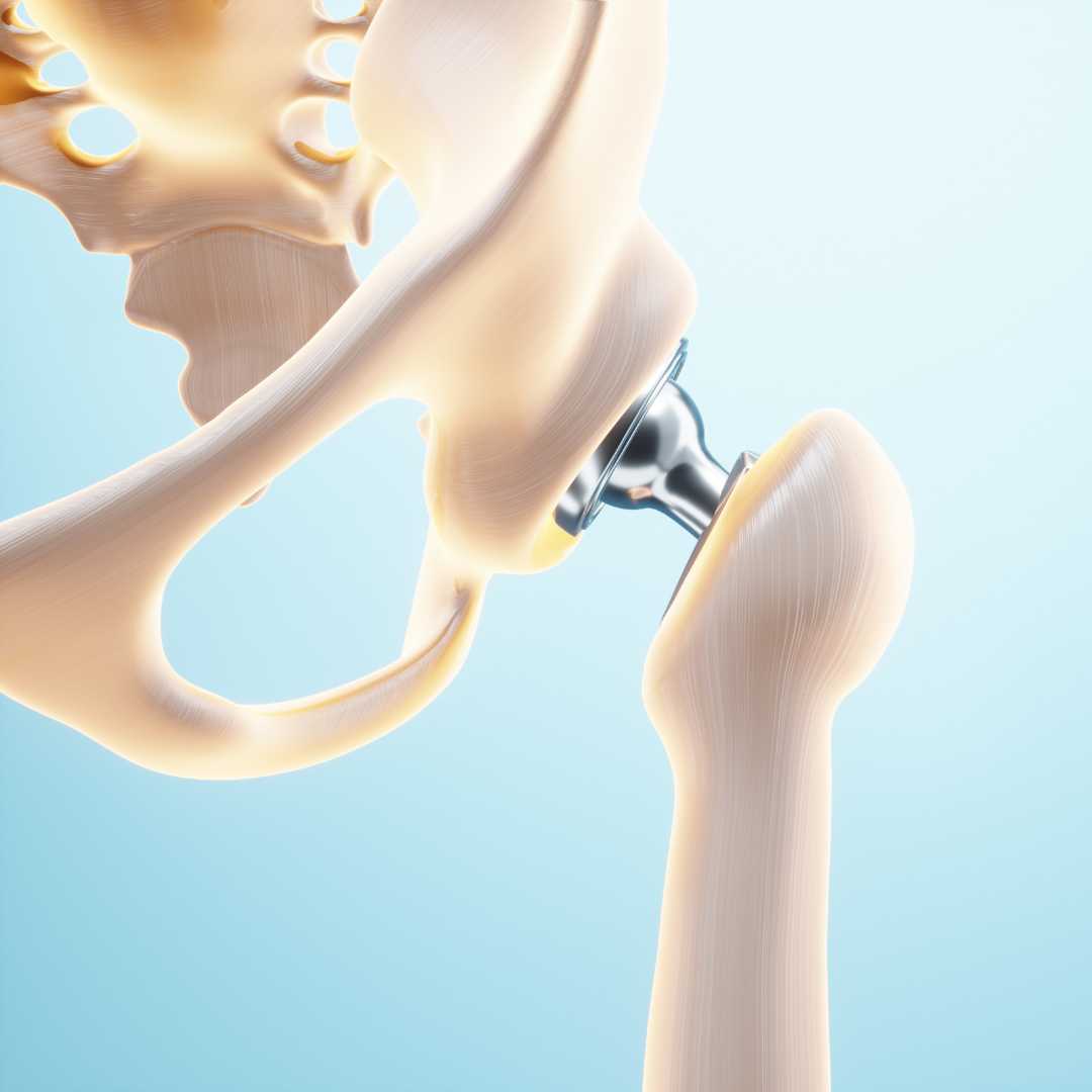 Hip Replacement Package by Group Florence in Istanbul, Turkey