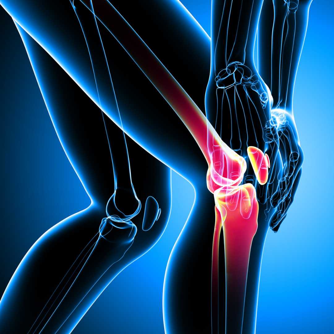 Knee Replacement Package in Istanbul, Turkey by Group Florence Nightingale Hospital