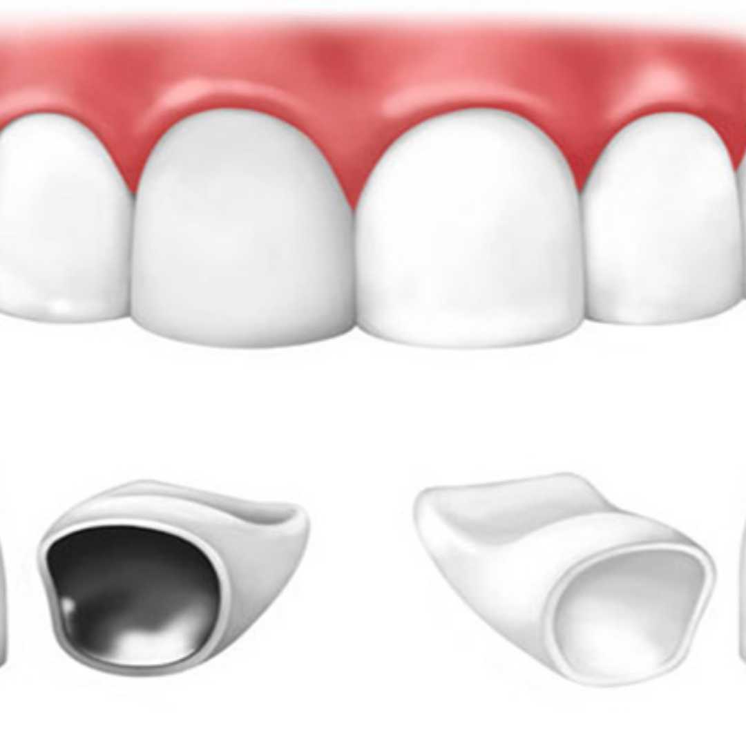 Dental Crowns at Americas Dental Care Costa Rica
