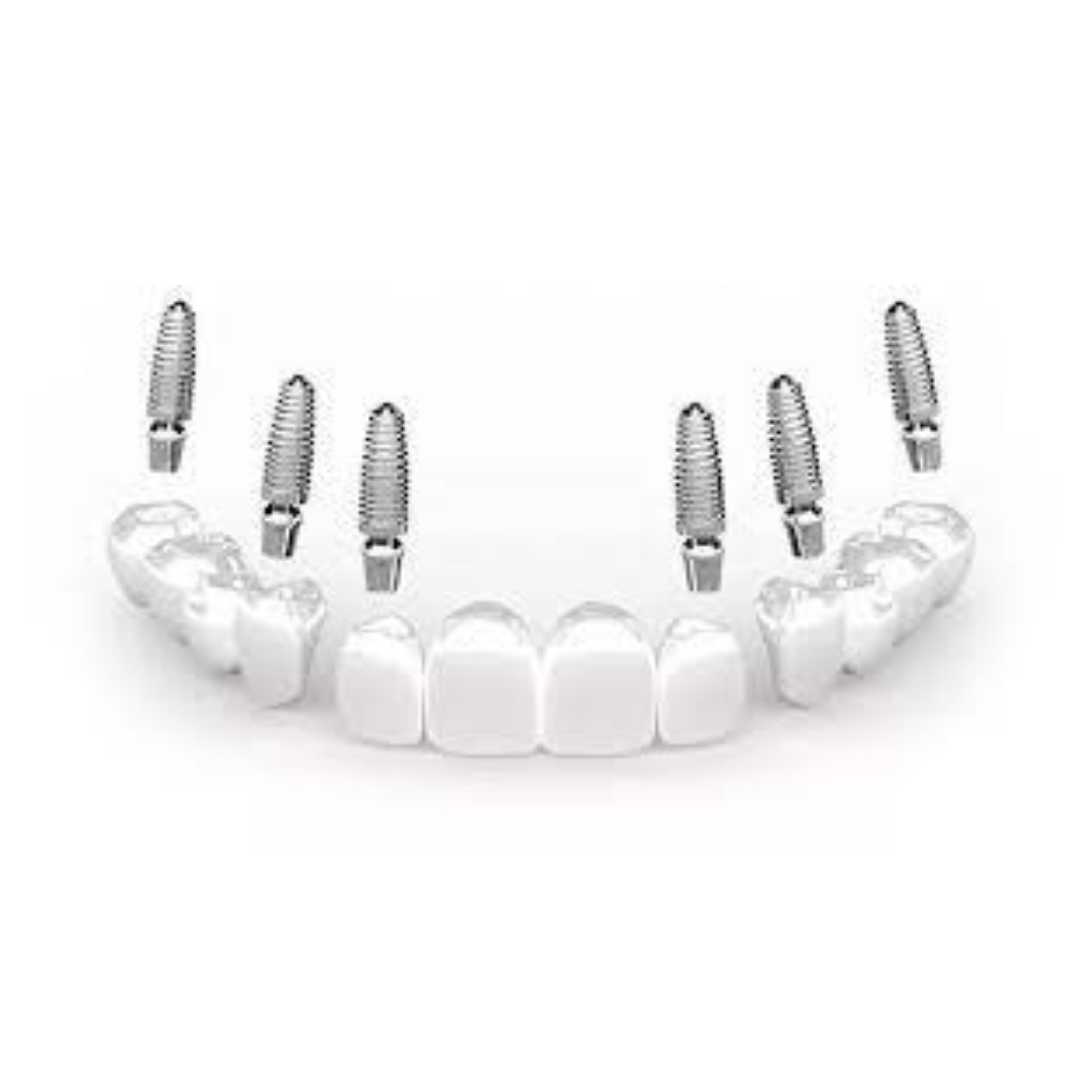 All on 6 Dental Implants Package in Los Algodones, Mexico