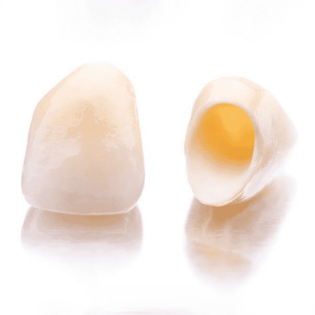 Dental Crowns at Simply Dental Los Algodones Mexico