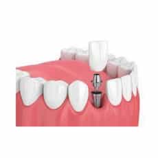Affordable Packages for Dental Implants in Cancun, Mexico