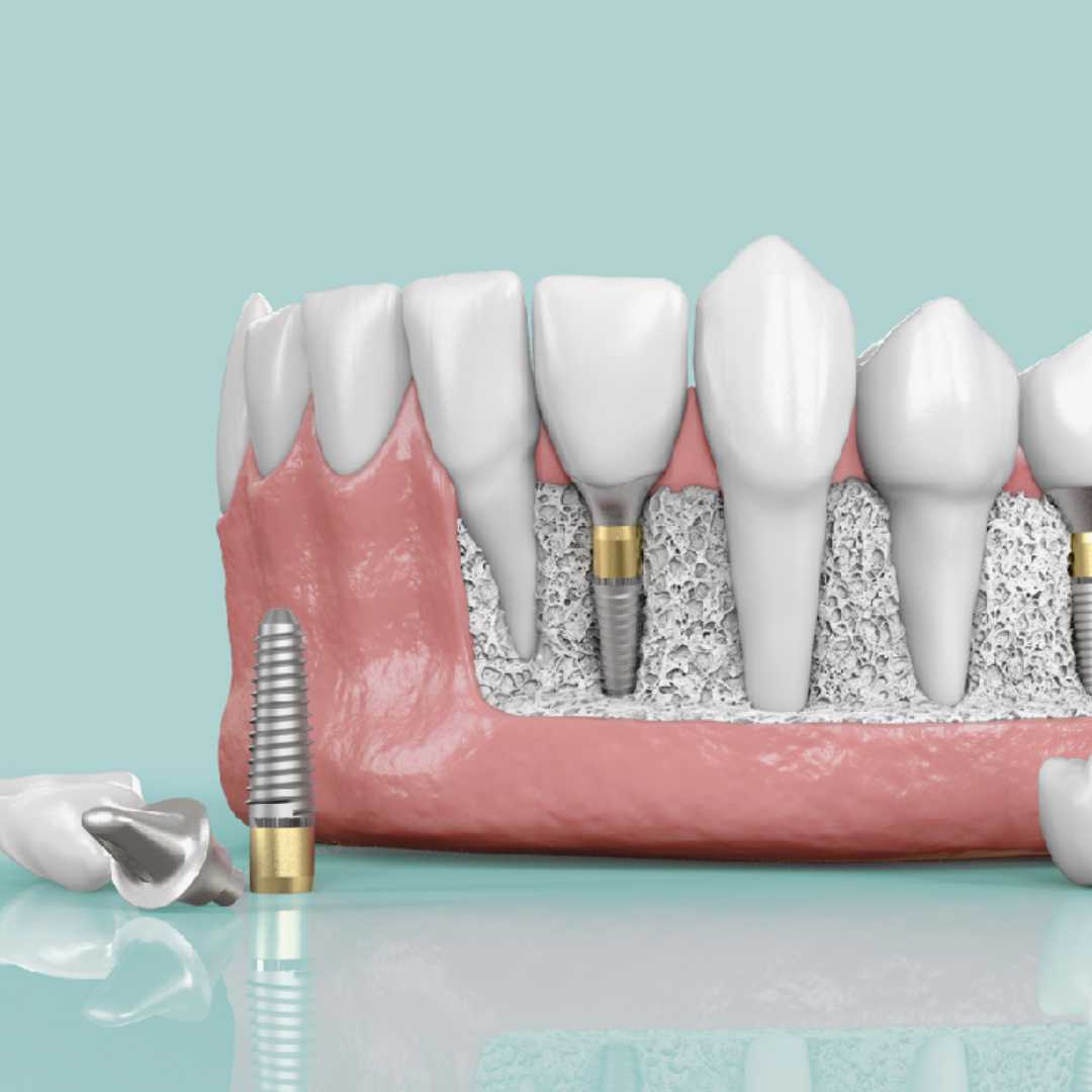 Best Dental Implant Package in San Jose Costa Rica