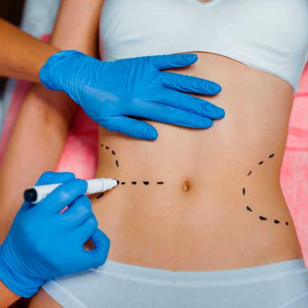 Liposuction in Cancun Mexico - Cheapest Package in $4,500