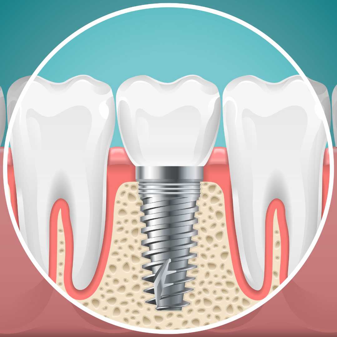 Dental Implants in Colombia - Affordable Tooth Replacement