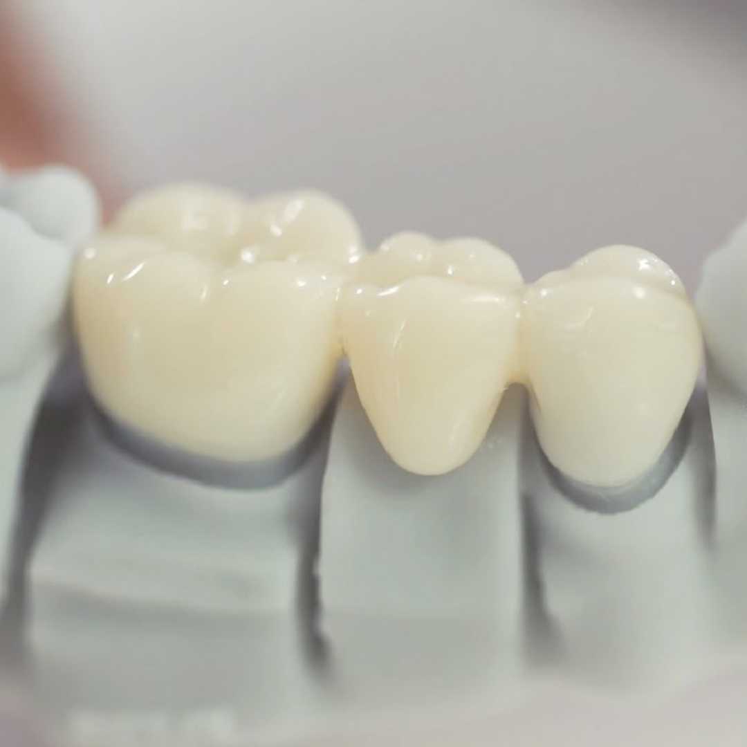 Davinci Top Dental Crowns in San Jose Costa Rica