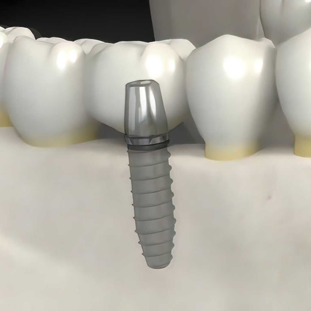 Dental Implants Turkey - Best Package in Istanbul - $800