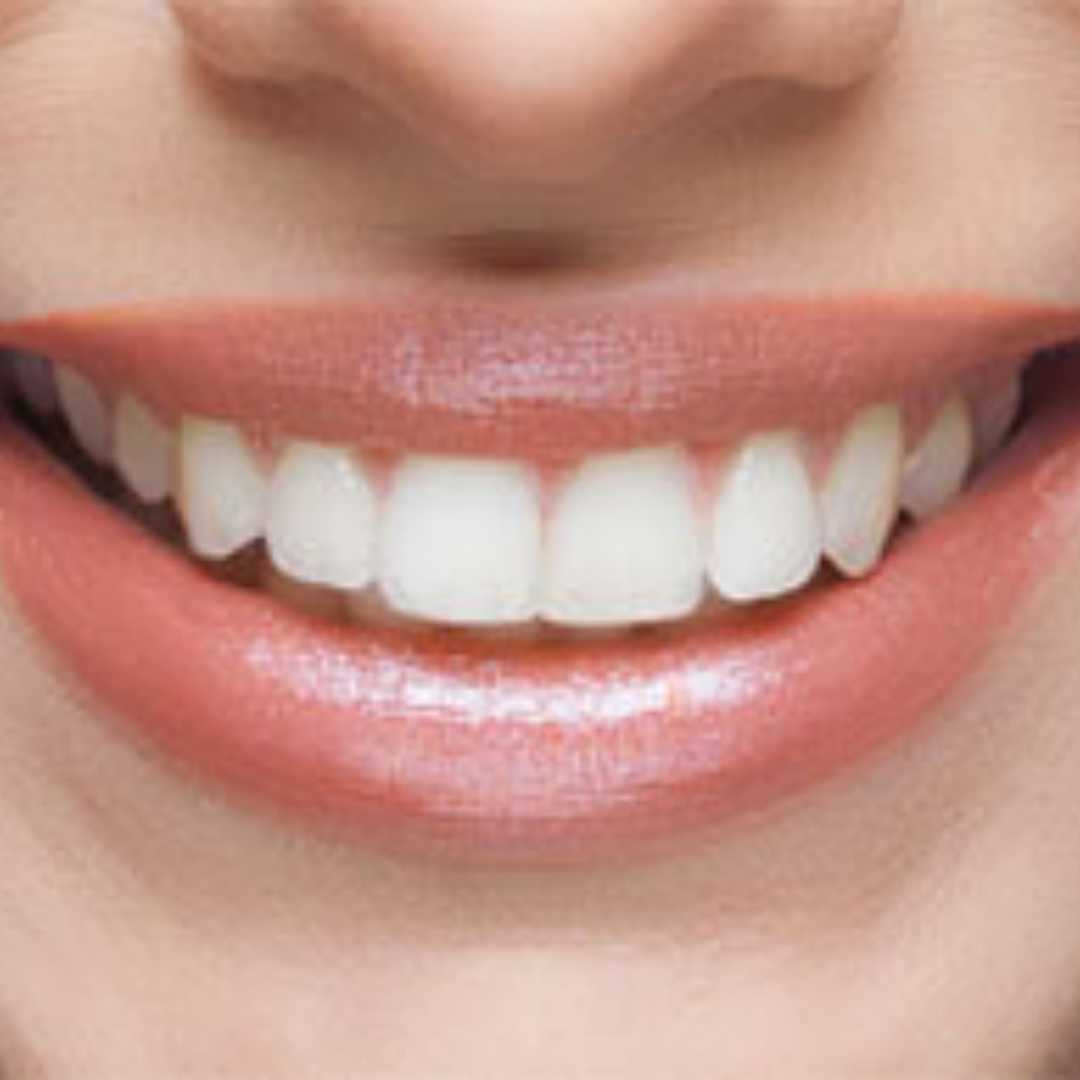 All on 4 Dental Implants Package in Cancun, Mexico