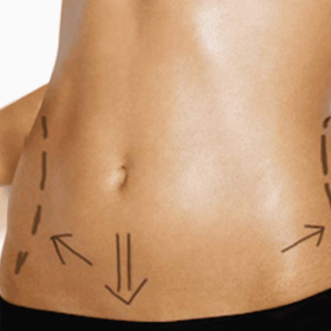 Affordable Package for Liposuction by Gastelum in Tijuana, Mexico