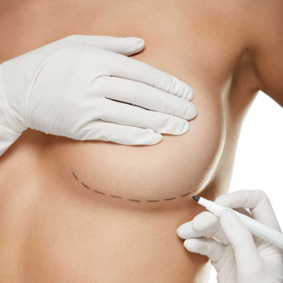 Low-Cost Package for Breast Lift with Implants in Mexico
