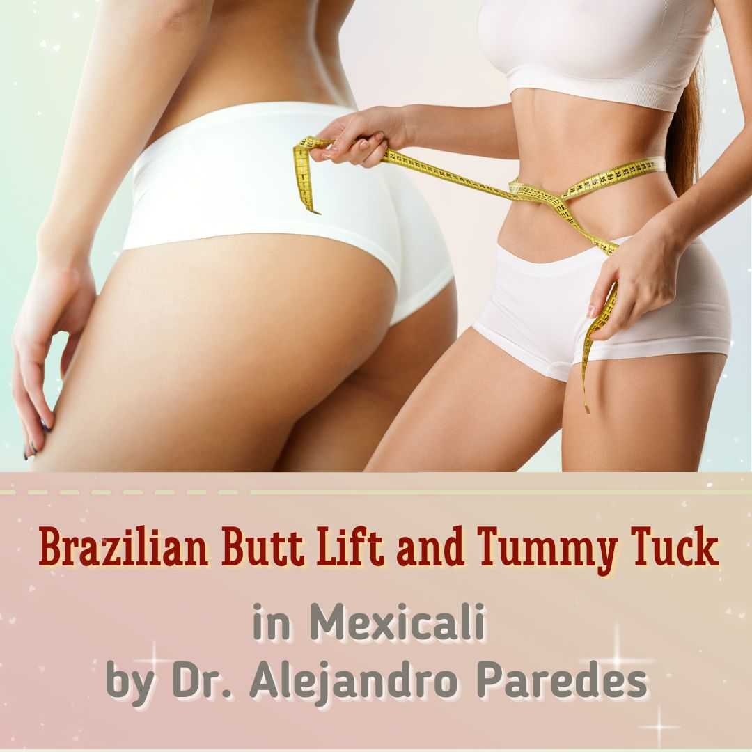 BBL + Tummy Tuck in Mexicali by Dr. Alejandro Paredes