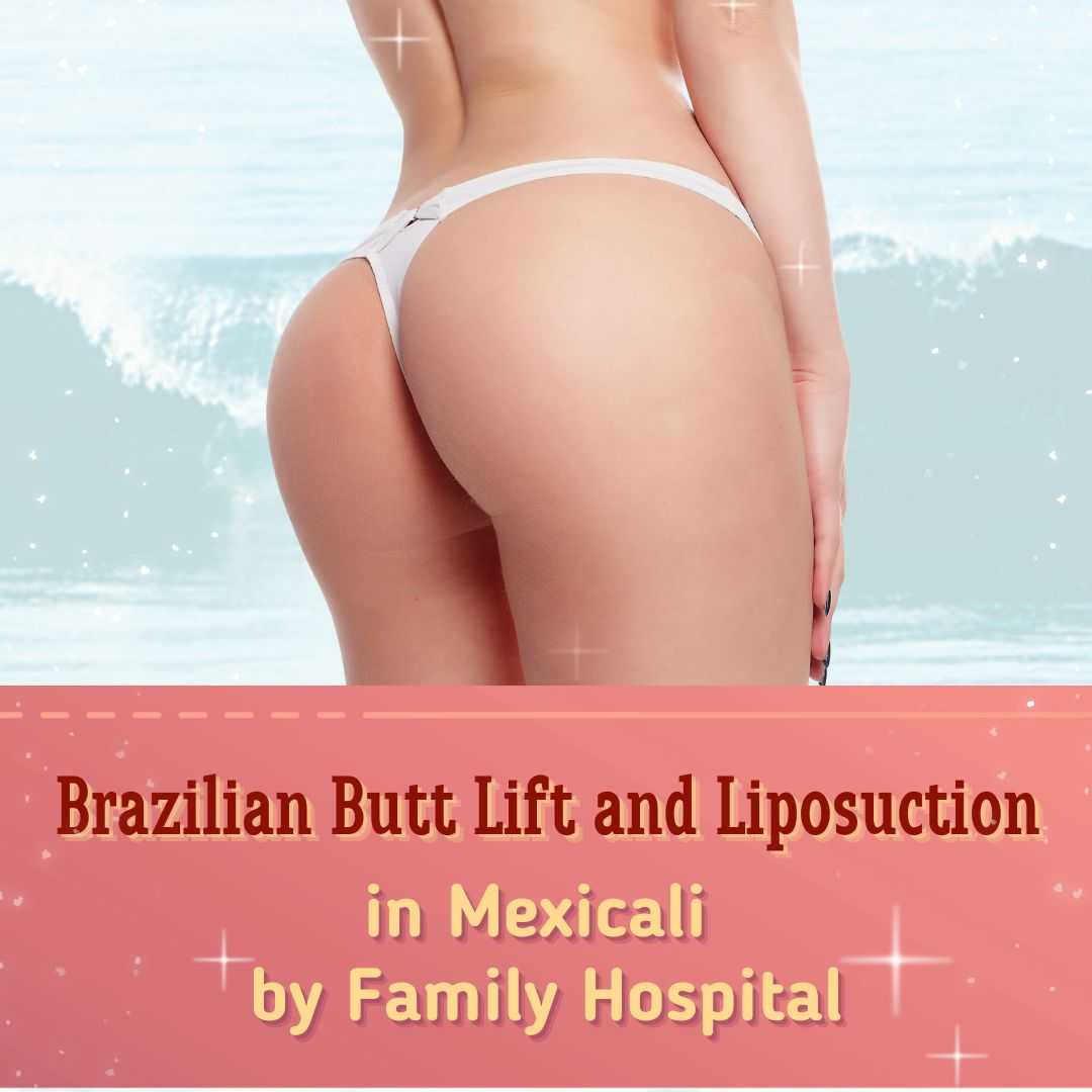 Brazilian Butt Lift and Liposuction in Mexicali