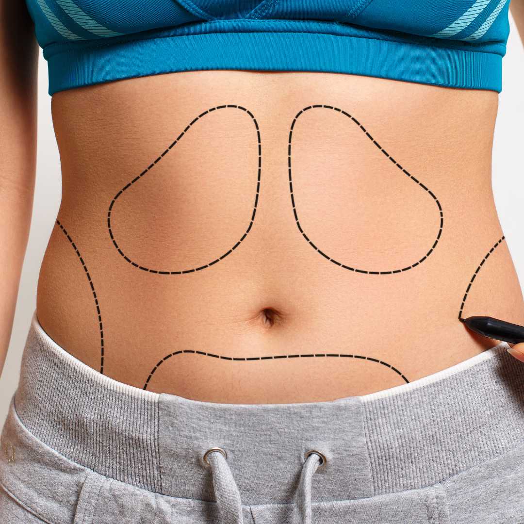 Low-Cost Package for Liposuction in Bangkok Thailand by BPS