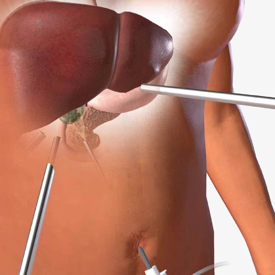 Laparoscopic Solutions Gallbladder Surgery Package in Piedras Negras, Mexico