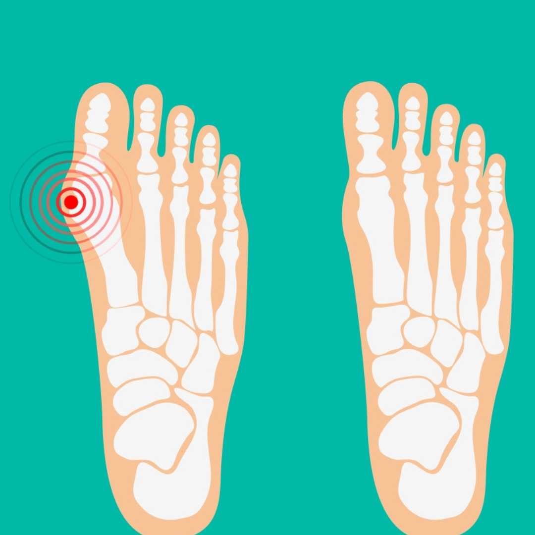 Hallux Valgus / Bunionectomy Surgery with LAPIDUS 3D Technology in Istanbul, Turkey