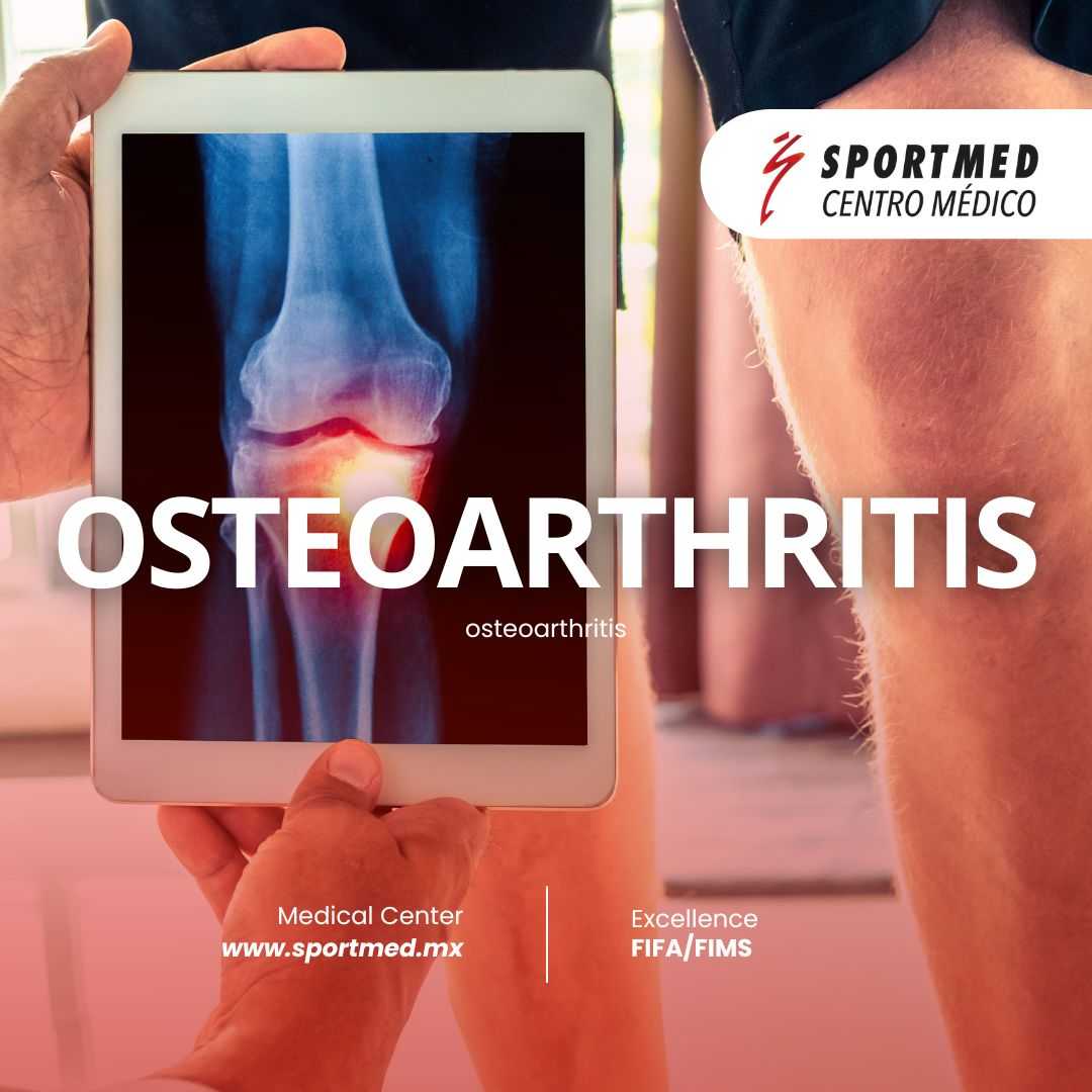 Regenerative Medicine for Osteorthritis in Sport Med Guadalajara and Puerto Vallarta Mexico