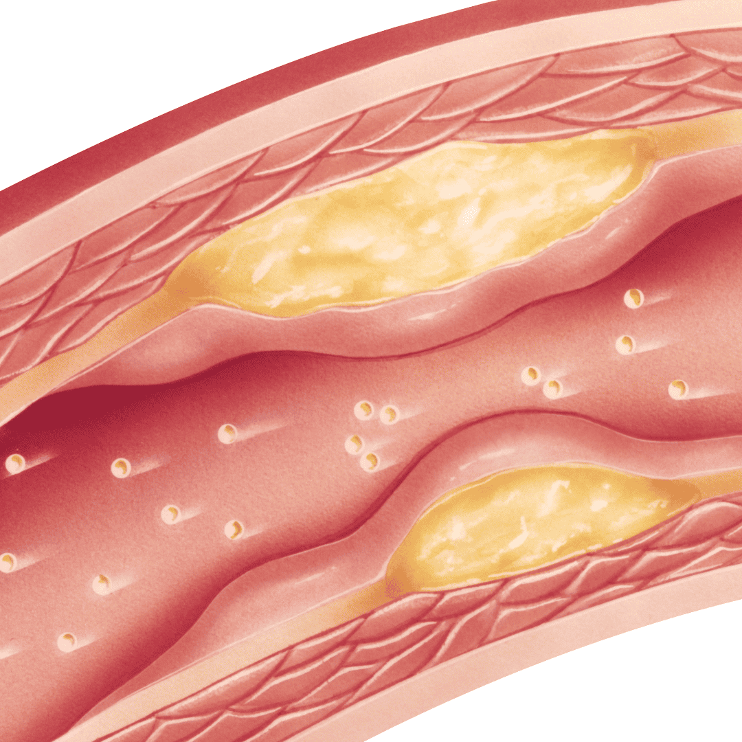 Stem Cell Therapy for Atherosclerosis Package at Stem Cells Kyron Colombia