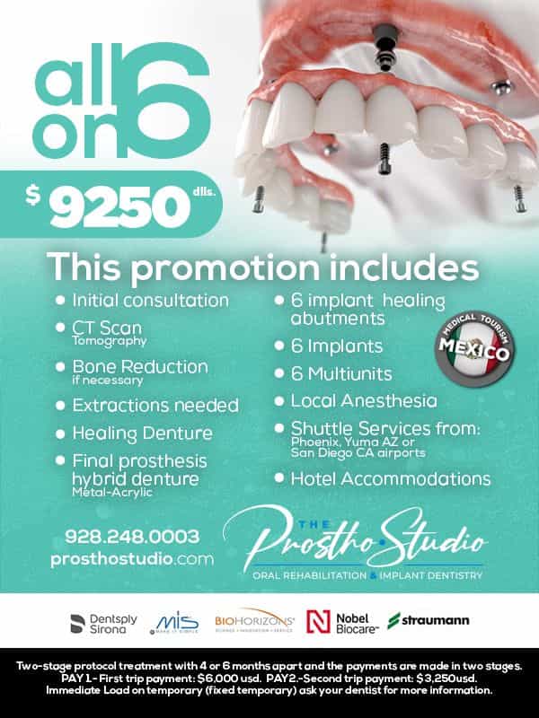 Dental Implants Los Algodones: All on 6 Package by The Prostho Studio in Mexico